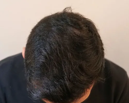 After Hair - AKL