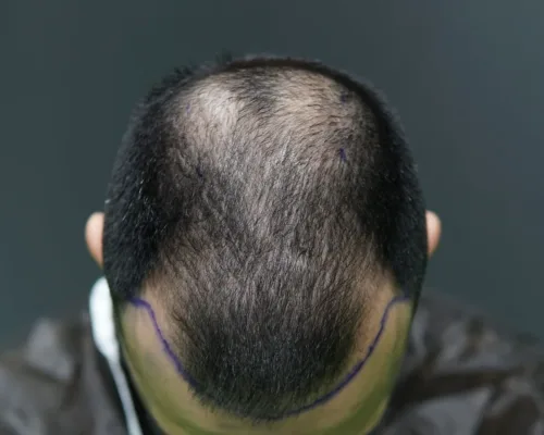 Before Hair - AKL