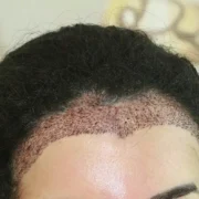 Greffe de Cheveux pour Femmes
