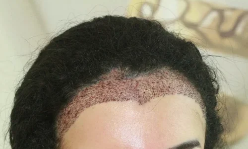 Trapianto di Capelli per Donne