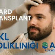 Beard Transplant