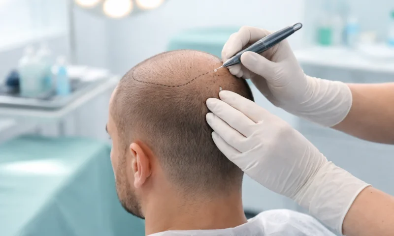 Greffe de Cheveux FUE Saphir