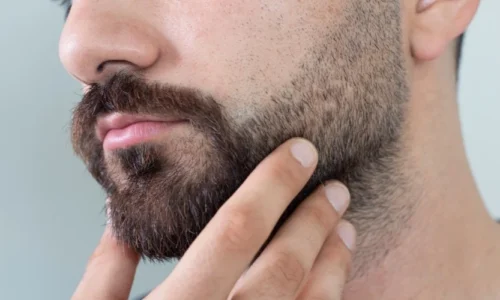 Greffe de barbe et de sourcils