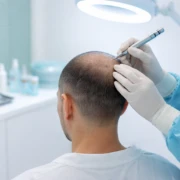 Trapianto di Capelli
