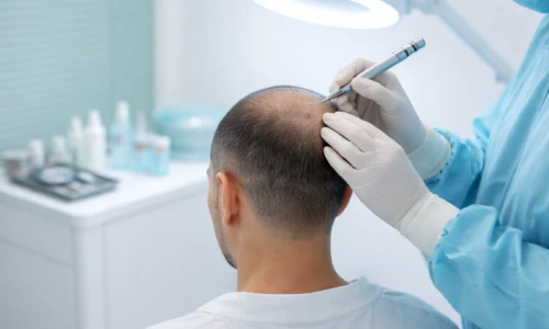 Trapianto di Capelli