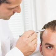 Long DHI Hair Transplant