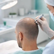 Trapianto di Capelli a Istanbul