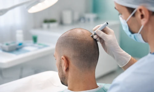 Trapianto di Capelli a Istanbul